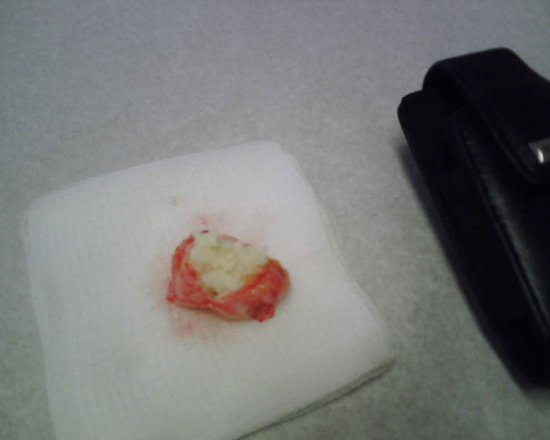 Pilonidal Cyst So How Many Of You Hairy Ers Got One Flat